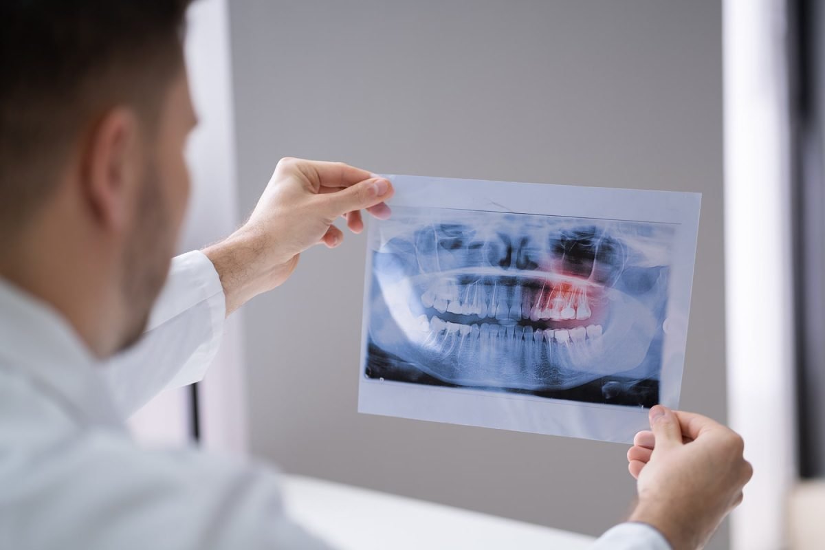 Wisdom teeth consultation in Lake Orion, MI